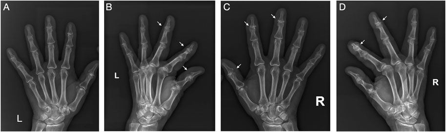 Adipokine Signaling Pathways in Osteoarthritis